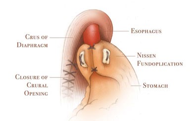 Surgical management of GERD model 1